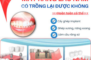 MẤT RĂNG LÂU NĂM – CÓ KHẢ NĂNG TRỒNG LẠI ĐƯỢC KHÔNG?