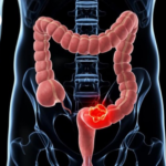 Những thắc mắc thường gặp khi muốn nội soi tiêu hóa