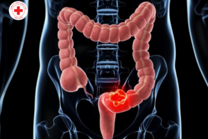 Những thắc mắc thường gặp khi muốn nội soi tiêu hóa