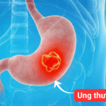 PHÁT HIỆN UNG THƯ DẠ DÀY DÙ KHÔNG CÓ TRIỆU CHỨNG BẤT THƯỜNG