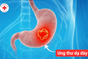 PHÁT HIỆN UNG THƯ DẠ DÀY DÙ KHÔNG CÓ TRIỆU CHỨNG BẤT THƯỜNG